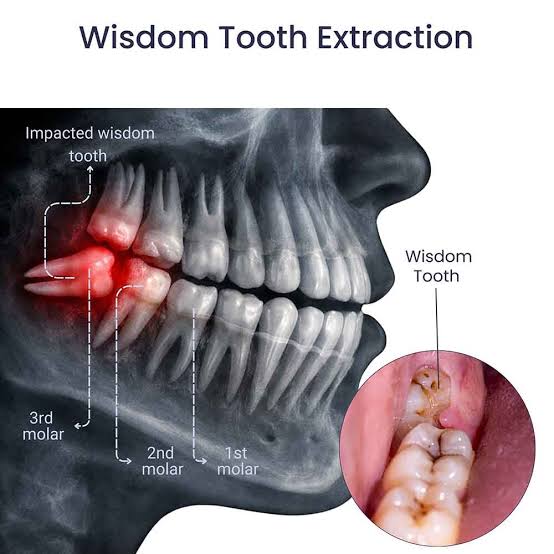 Wisdom Teeth Removal